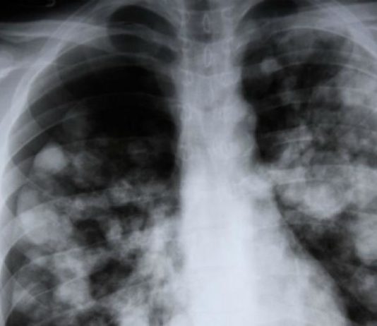 Una mujer recibió los pulmones de una fumadora y murió de cáncer en Francia