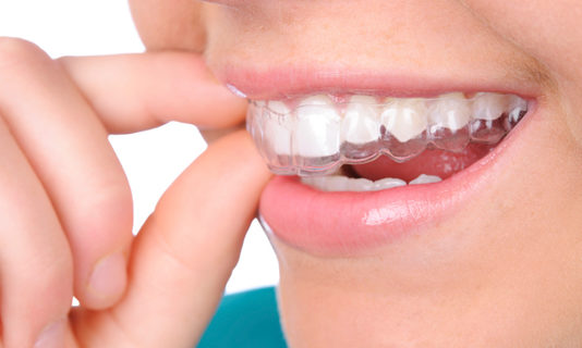 Nuevas tendencias en tratamientos de ortodoncia en Tucumán Ortodoncia invisible en tucuman