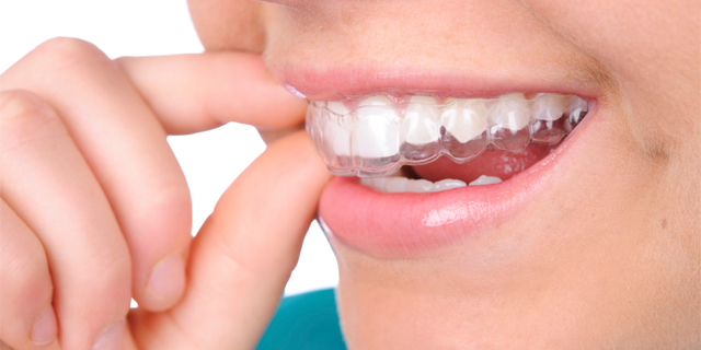 tucuman-ortodoncia-invisible Ortodoncia invisible en tucuman